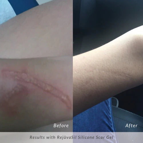 Rejuvaskin - "Silicone Scar" Gel
