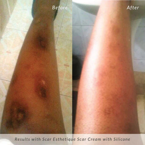 Rejuvaskin - "Scar Esthetique Scar" krem