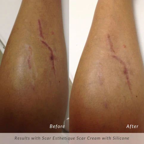 Rejuvaskin - "Scar Esthetique Scar" krem
