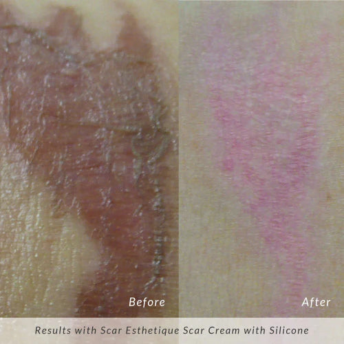 Rejuvaskin - "Scar Esthetique Scar" krem